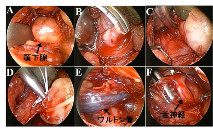 内视镜支援下颚下腺摘出术